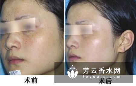 眼角长雀斑是什么原因 怎么办