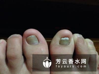 顽固性肥胖是什么原因有哪些
