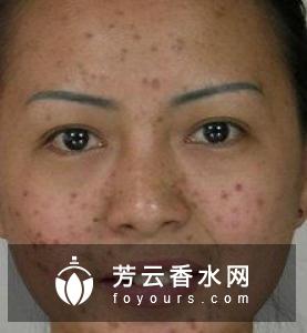 脸上长粉刺可以用用吗硫磺皂洗脸的好处和坏处有哪些?