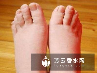 手臂水肿是什么原因?怎么消除?