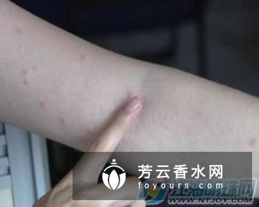 眼睛周围的皮肤干燥还痒怎么办