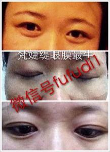 眼部按摩仪可以去眼袋吗 可以去眼纹吗