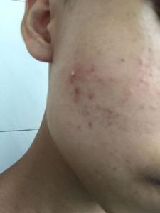 左右脸颊反复长痘怎么办 什么原因引起的