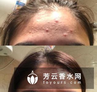 a酸可以去闭口粉刺吗 可以长期使用吗