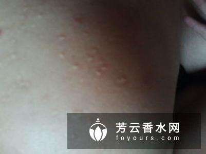 后背肉多是什么原因 怎么减