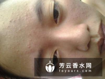 a酸可以去闭口粉刺吗 可以长期使用吗