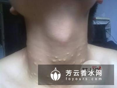 后背肉多是什么原因 怎么减